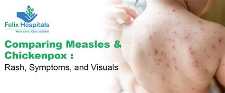 Can smallpox come back?